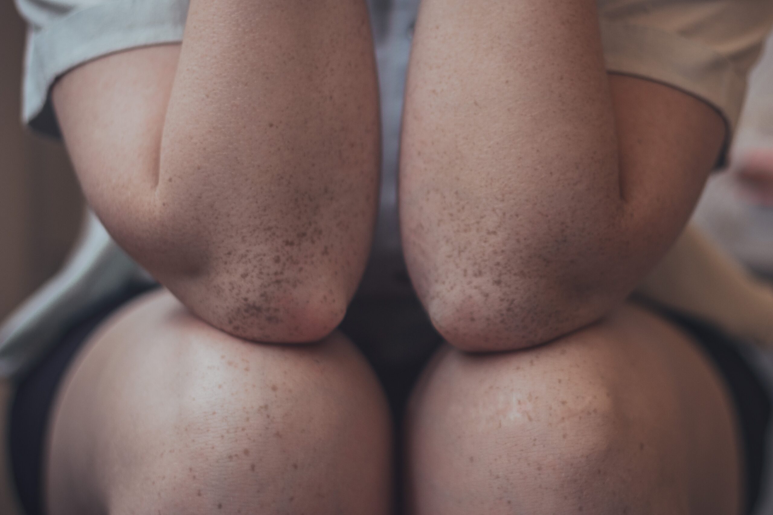 Early signs of skin cancer and when to see a dermatologist.