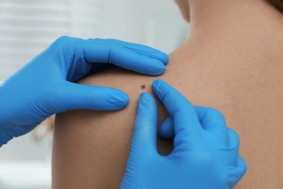 Doctor wearing blue gloves examining a mole on a patient’s shoulder for dermatology care.